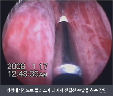 방광내시경으로 플라즈마 레이져 전립선 수술을 하는 장면